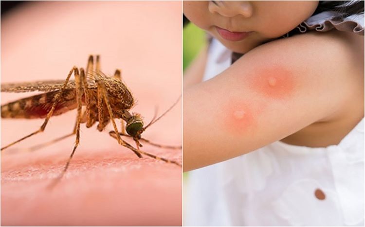 Cách xử lý khi bị côn trùng cắn