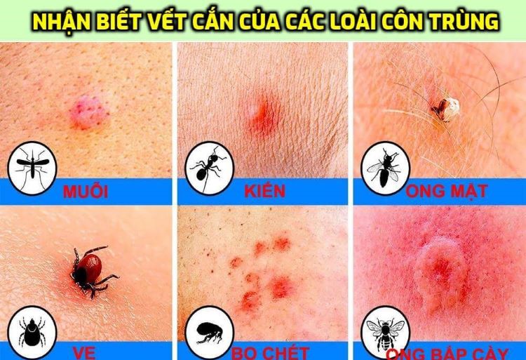 Cách xử lý khi bị côn trùng cắn