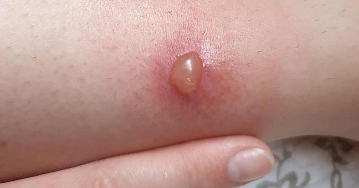 Vết côn trùng cắn sưng đỏ ngứa