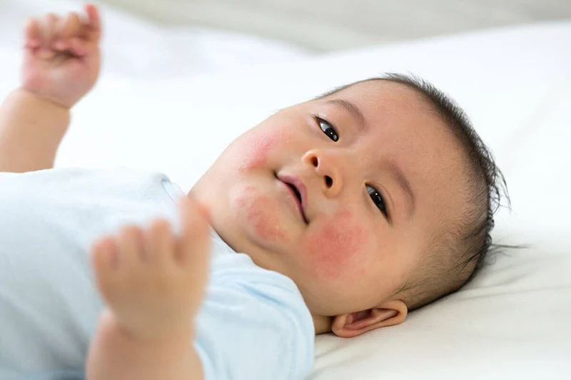 Trẻ bị nổi mẩn đỏ như muỗi đốt