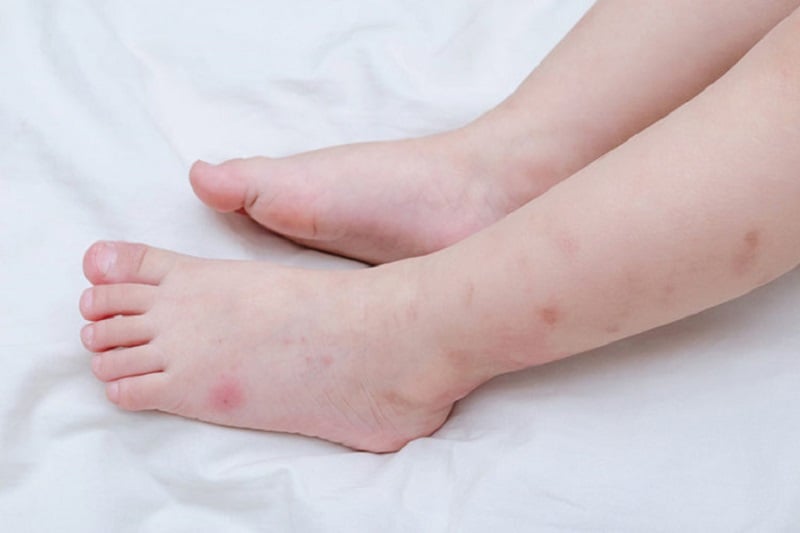 Trẻ bị nổi mẩn đỏ như muỗi đốt
