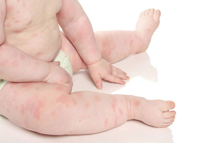 Trẻ bị nổi mẩn đỏ như muỗi đốt