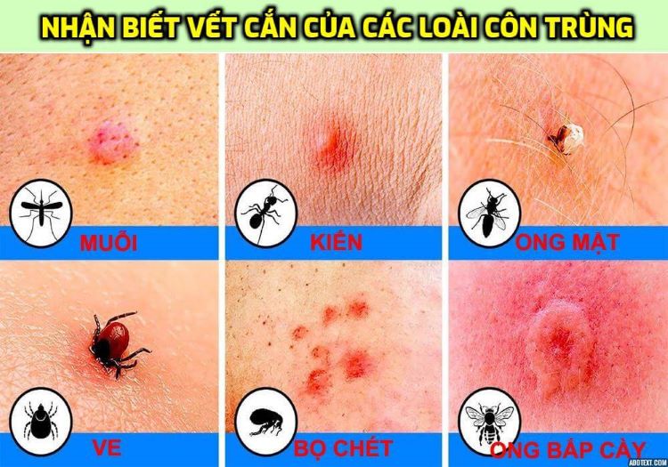 Vết côn trùng cắn sưng đỏ ngứa