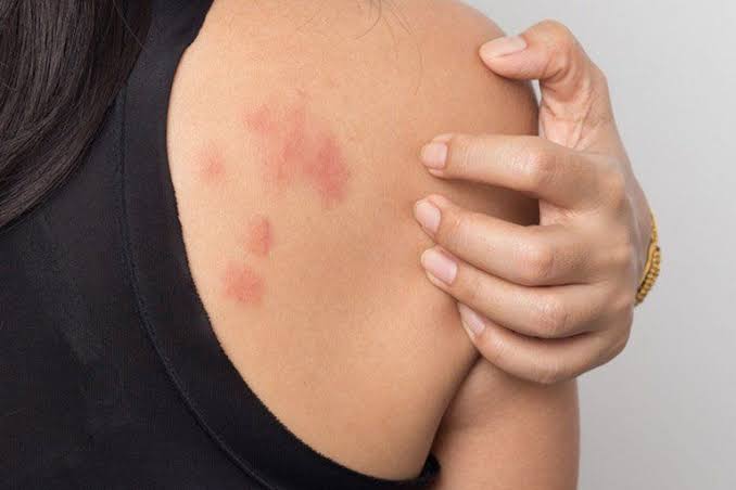 vết côn trùng cắn sưng đỏ ngứa