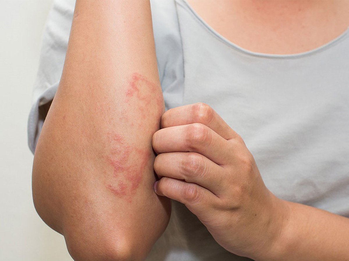 vết côn trùng cắn sưng đỏ ngứa
