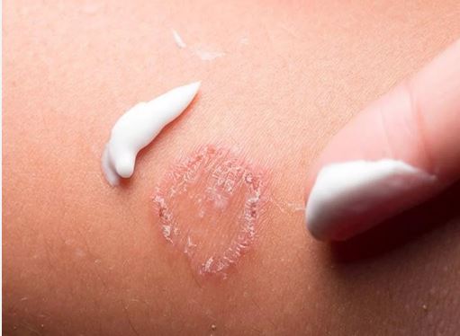 vết côn trùng cắn sưng đỏ ngứa