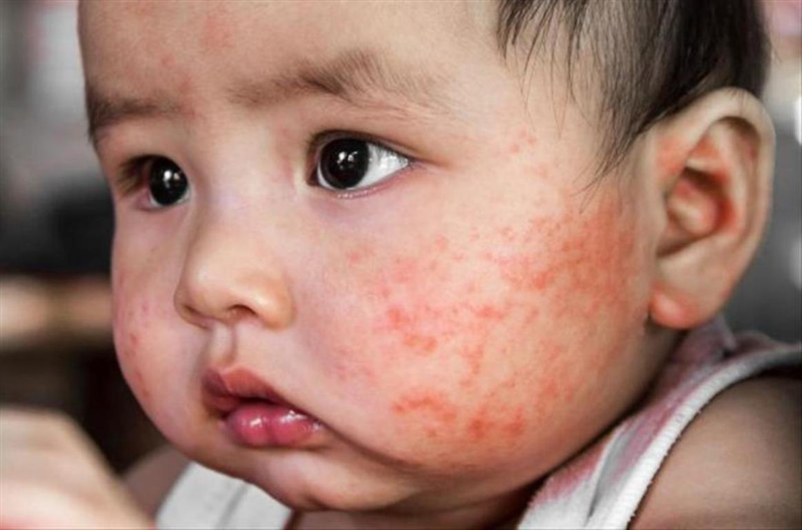 Trẻ bị nổi mẩn đỏ như muỗi đốt